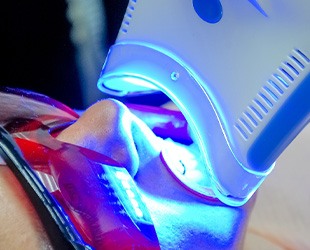 Patient undergoing in-office teeth whitening treatment