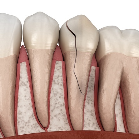 cracked tooth