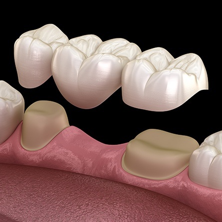 computer illustration of dental bridge