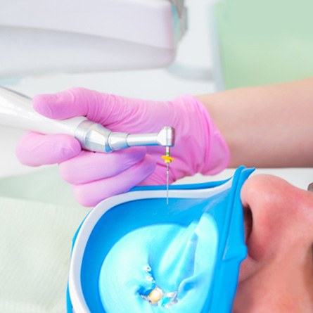 Cost of root canal therapy in San Antonio 