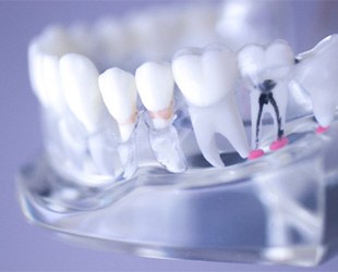 The root of a tooth in San Antonio