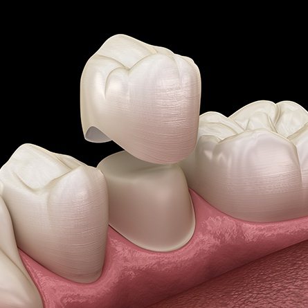 all ceramic dental crowns