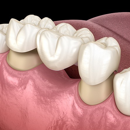 all ceramic dental bridge