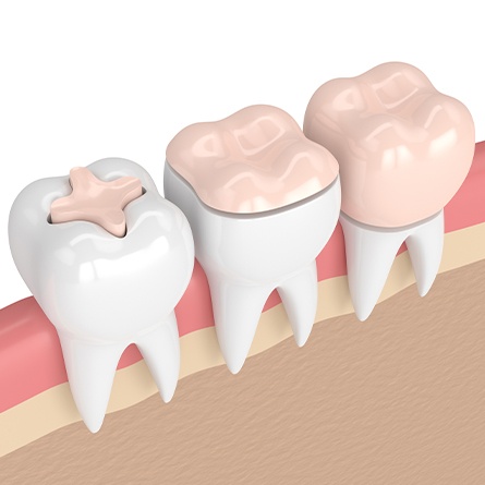 three types of dental crowns