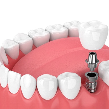 Imagen 3D de un implante dental, pilar y corona