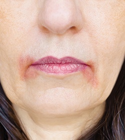 example of angular cheilitis