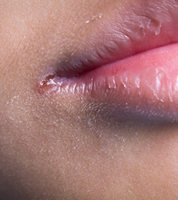 example of angular cheilitis