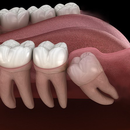 impacted wisdom tooth