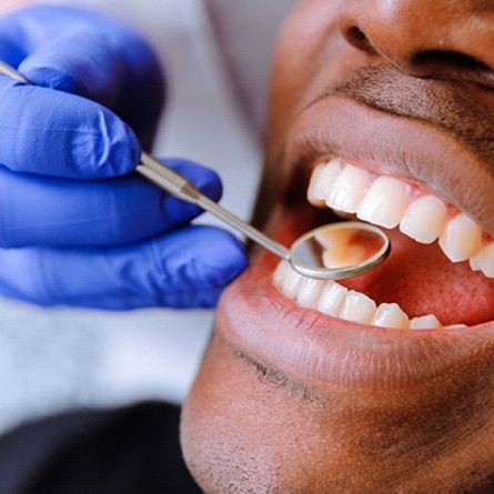 An up-close look at a dentist using a dental mirror to check a patient’s teeth and gums