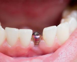 patient smiling with dental implant in mouth  