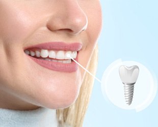 patient smiling with dental implant in mouth   