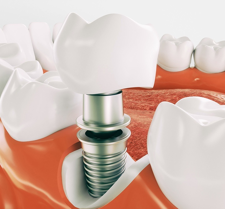 enlarged dental implant