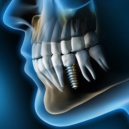 implant in jaw