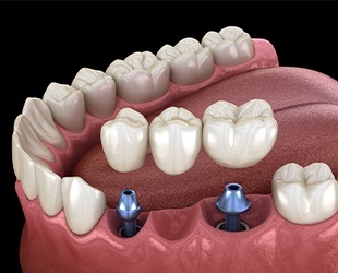 dental bridge