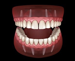 illustration of implant retained dentures