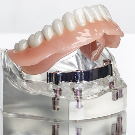 implant detained denture