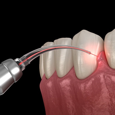 Soft tissue laser treating gums in Alamo Ranch, TX