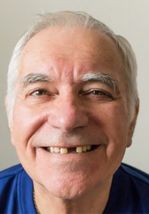 Patient in Helotes showing missing tooth