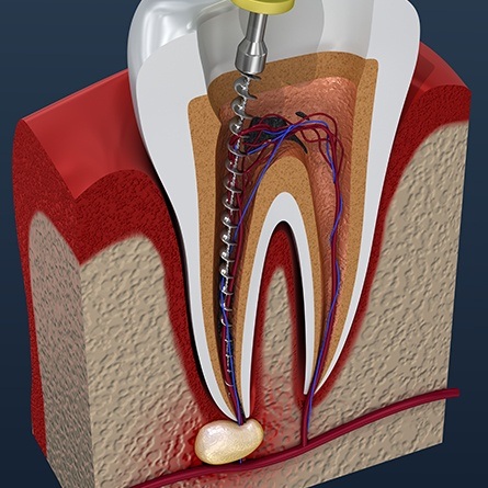 root canal illustrated