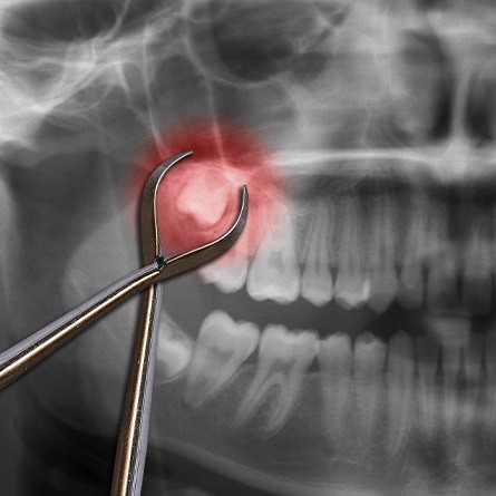 red tooth on x-ray