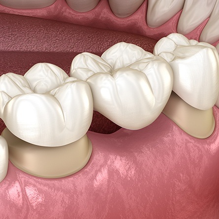 close up of dental bridge