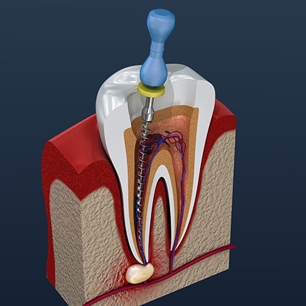 Computer illustration of root canal