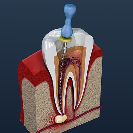Computer illustration of root canal