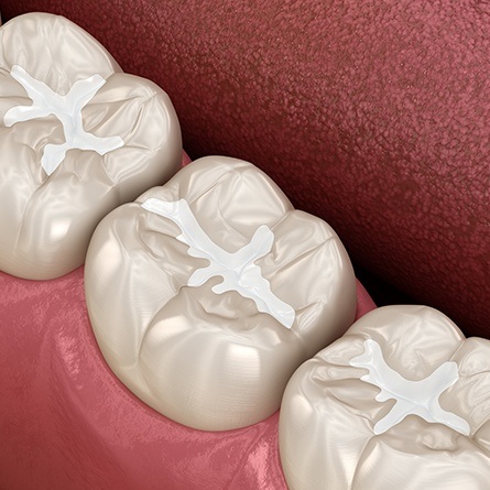 white dental sealants
