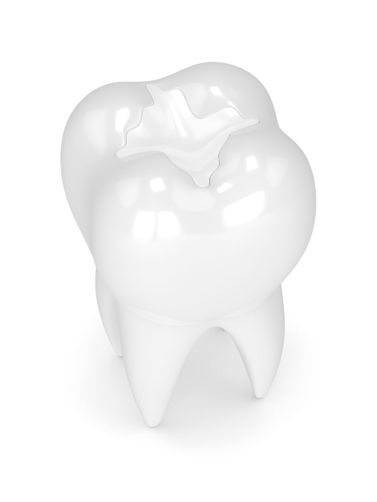 3D model of a tooth with a sealant