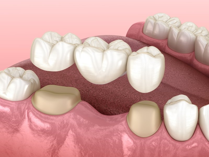 a dental bridge