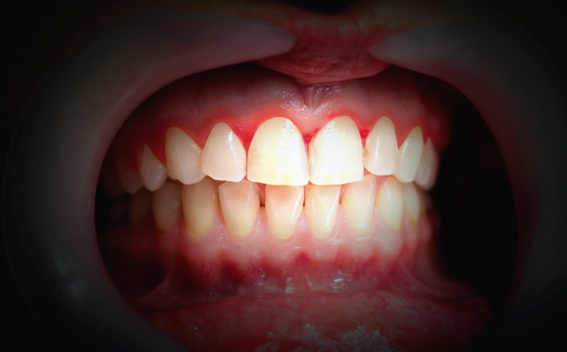 an up-close look at a person’s teeth and red gums