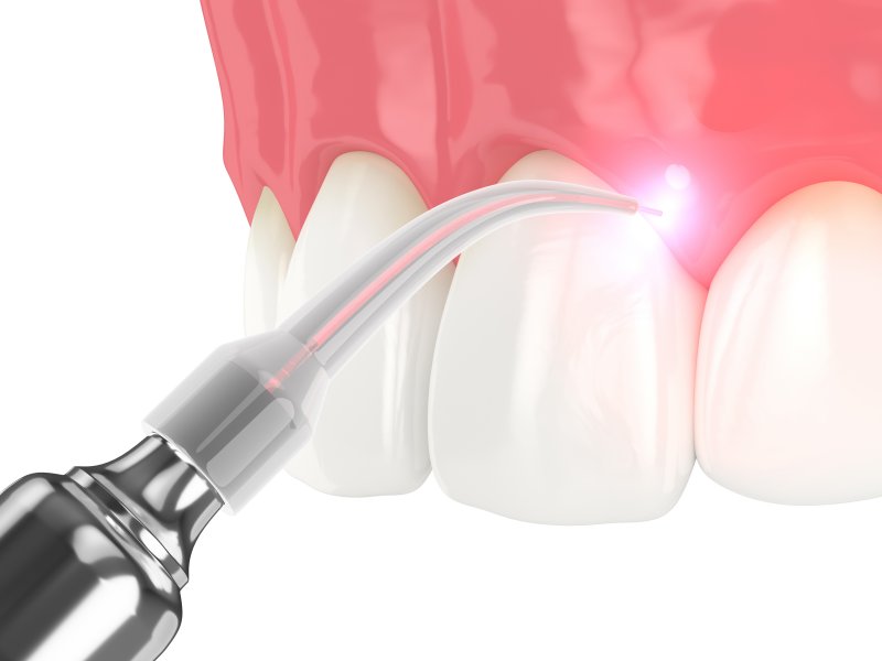 a soft tissue dental laser in Alamo Ranch